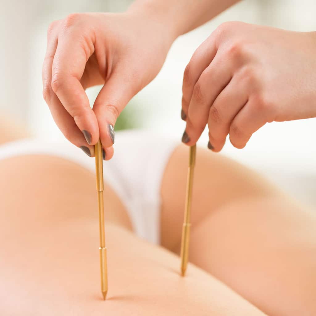 acupuncture et perte de poids