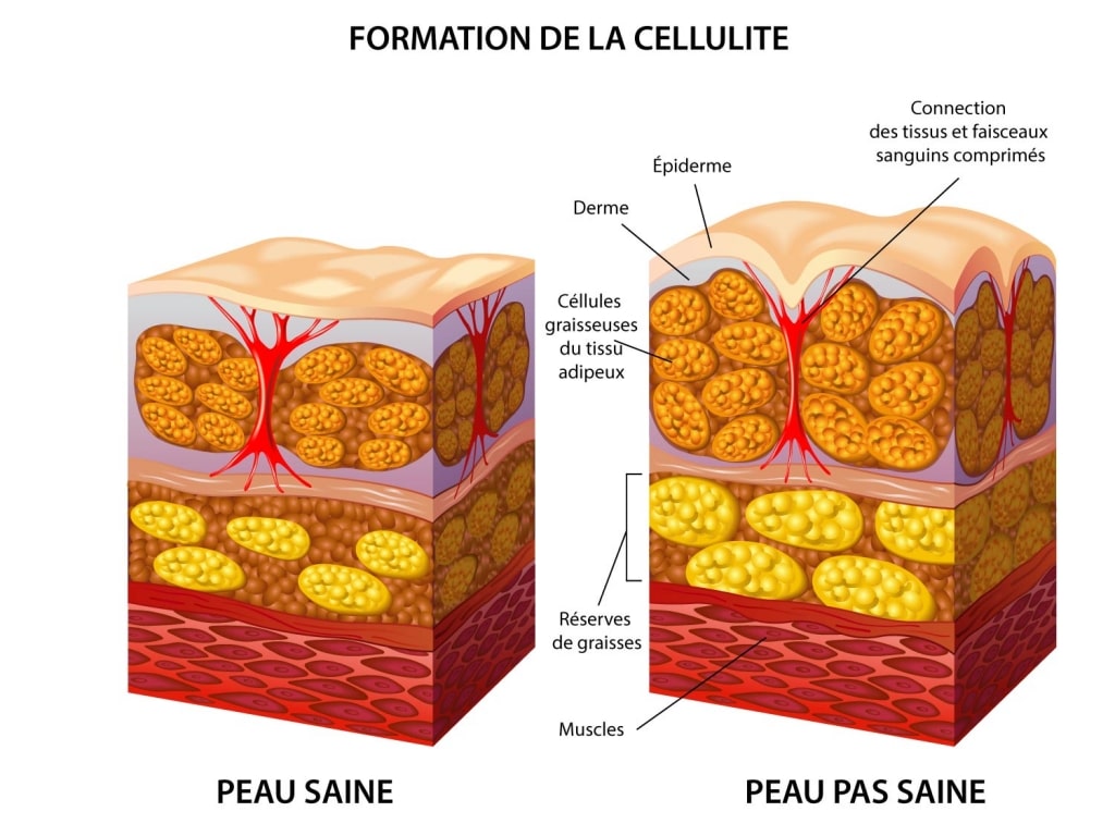 cellulite formation